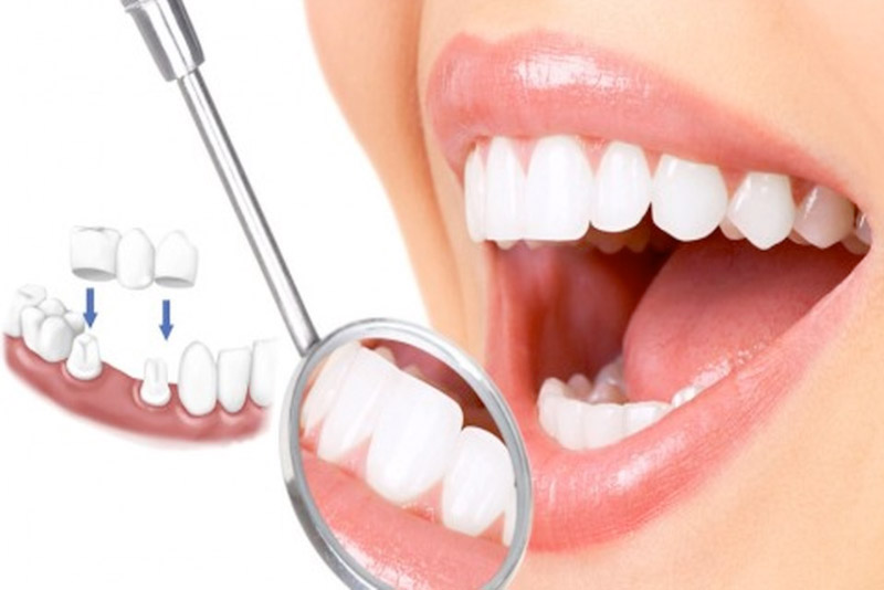 Quy trình trồng răng sứ còn phụ thuộc vào rất nhiều yếu tố