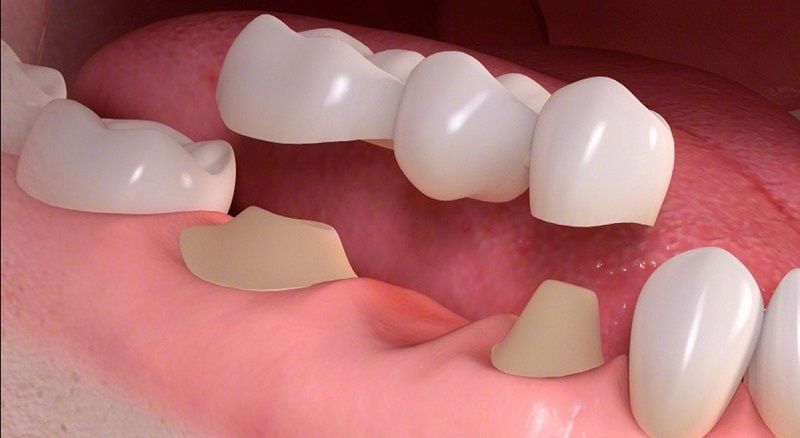 Có rất nhiều yếu tố làm ảnh hưởng đến thời gian trồng răng sứ