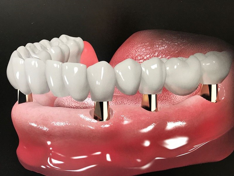 Trồng răng sứ nguyên hàm có đau nhưng không kéo dài lâu
