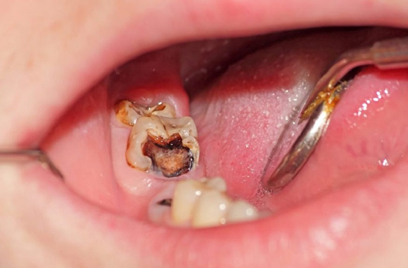 Tình trạng sâu răng nặng ba mẹ cần đưa đến gặp bác sĩ để được điều trị an toàn