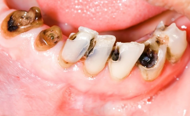 Sâu răng là bệnh lý răng miệng phổ biến