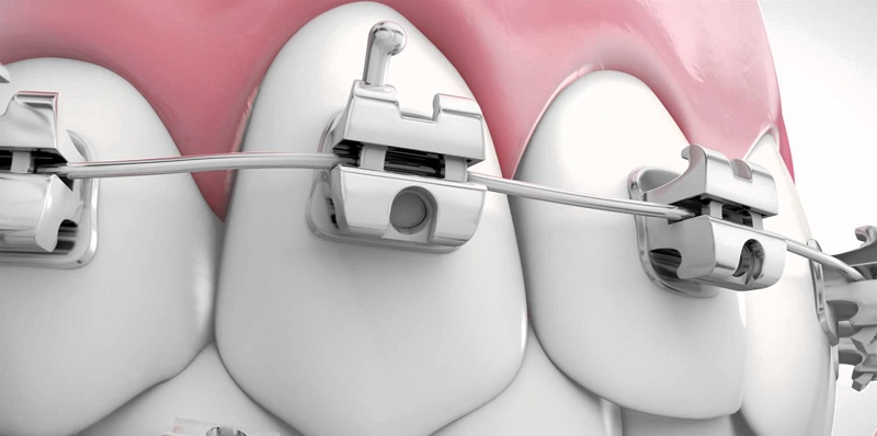 Chi phí niềng răng mắc cài tự đóng thường dựa theo mức độ nghiêm trọng của răng miệng