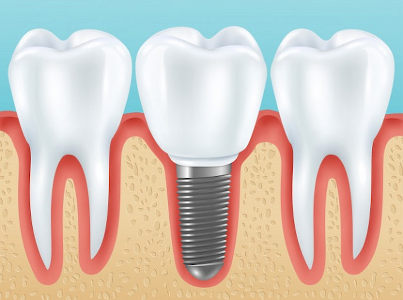 Phục hình răng implant là phương pháp hiện đại nhất hiện nay