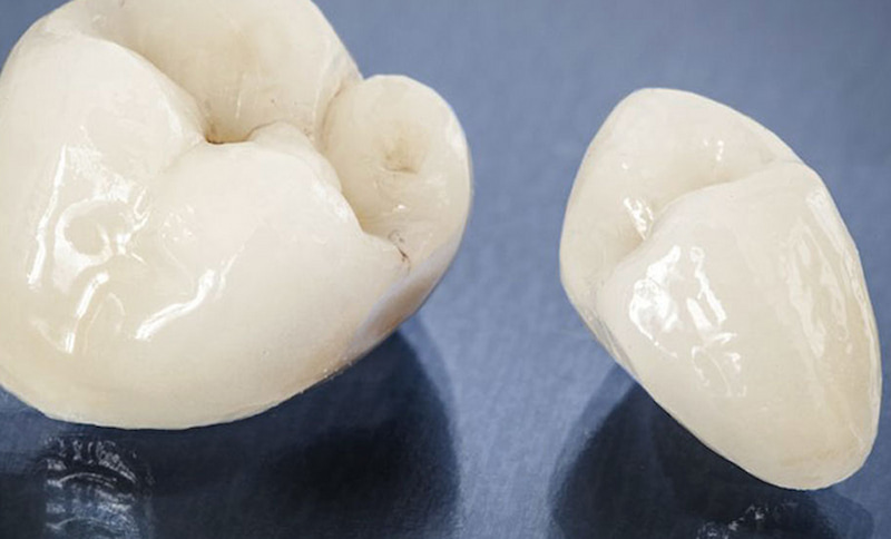 Giá trồng răng implant còn phụ thuộc vào nhiều khoản phí khác nhau