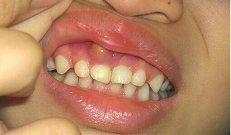 Viêm lợi là bệnh răng miệng thường gặp ở trẻ nhỏ
