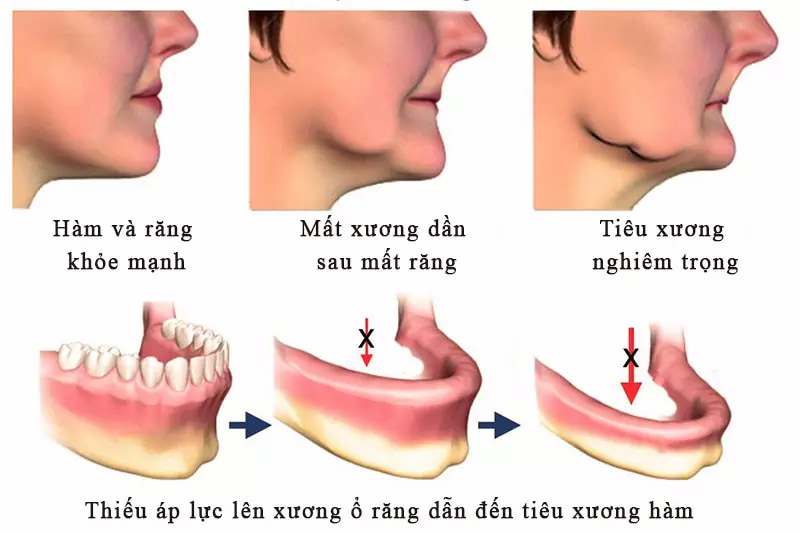 Nhiều người bị tiêu xương hàm do mất răng thời gian dài