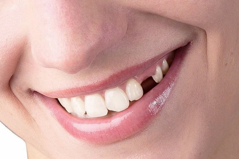 Nhổ răng không trồng lại gây mất thẩm mỹ khi cười nói