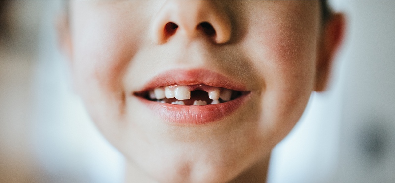 Có rất nhiều nguyên nhân khiến trẻ bị sâu răng