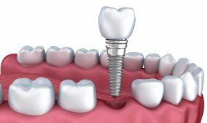 Quy Trình Trồng Răng Implant: 5 Bước Quan Trọng Không Thể Bỏ Qua