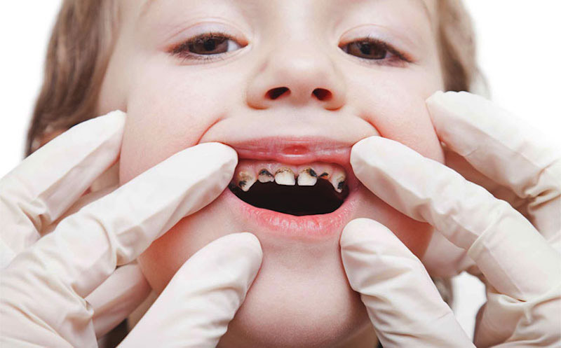 Biểu hiện răng sữa bị sâu ở trẻ có thể phát hiện bằng mắt thường