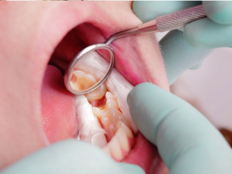Tùy theo tình trạng sâu răng bác sĩ sẽ có phương pháp điều trị phù hợp