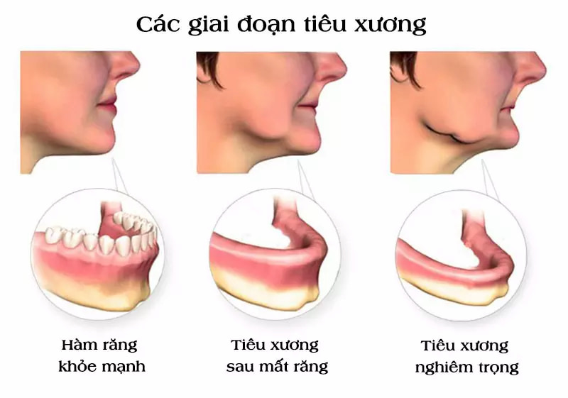 Mất răng cấm có thể gây ra tình trạng tiêu xương hàm