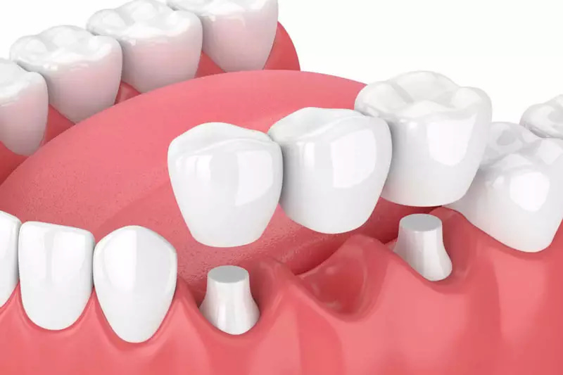 Trồng răng cấm bằng cầu sứ là phương pháp khá phổ biến