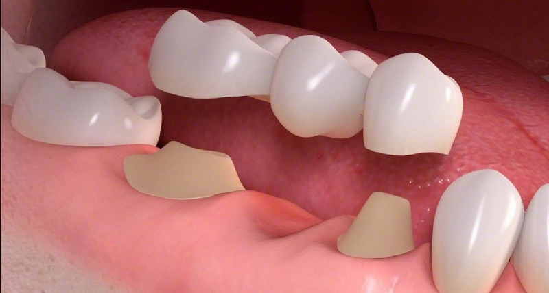 Trồng răng cấm bằng cầu sứ là biện pháp khá phổ biến