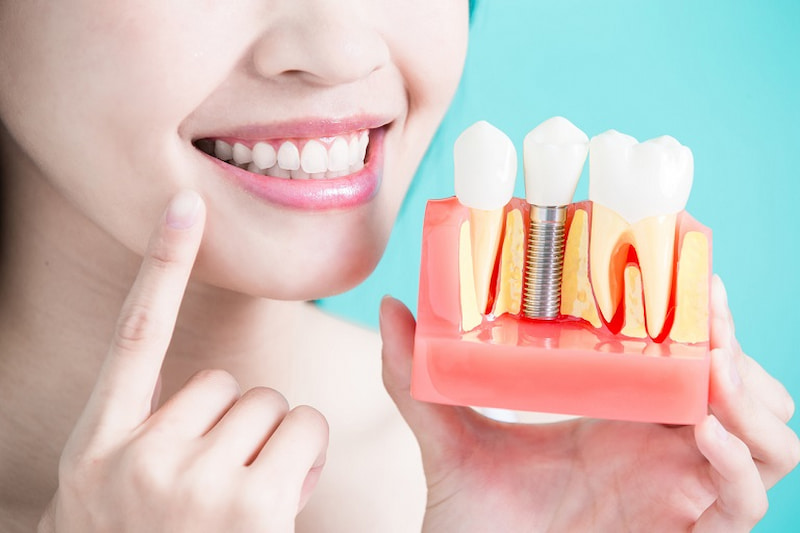 Cấy ghép implant là phương pháp phục hình răng đang trở nên phổ biến