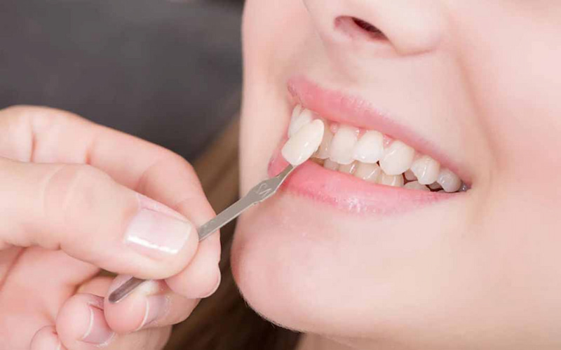 Mão sứ đảm bảo tính thẩm mỹ đối với người bị mất răng cửa
