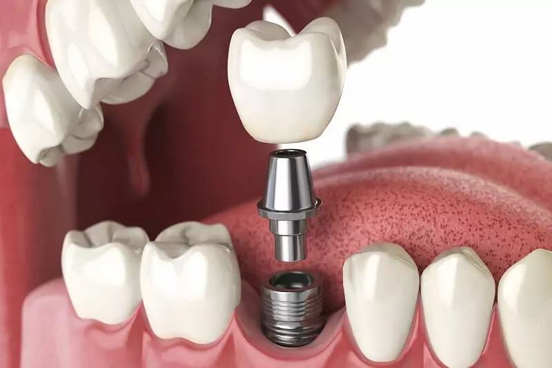 Trồng răng implant sử dụng trụ implant để thay thế cho chân răng bị mất