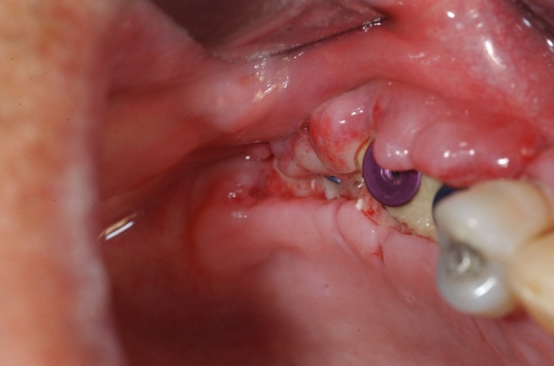 Trồng răng implant giá rẻ tiềm ẩn nguy cơ biến chứng nhiễm trùng sau phẫu thuật