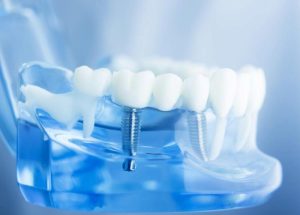 Trồng Răng Implant Mất Bao Lâu Thì Hoàn Thiện? [Bác Sĩ Giải Đáp]