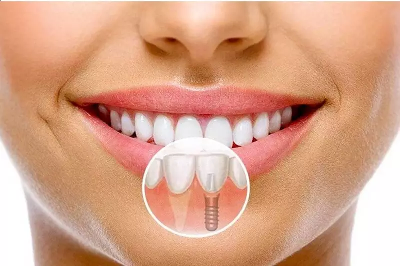 Bạn cần lựa chọn địa chỉ trồng răng implant uy tín chất lượng