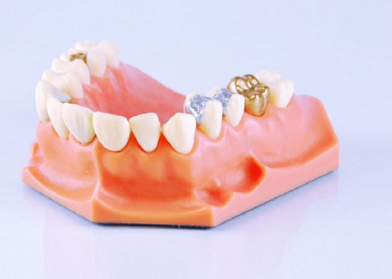 Răng vàng còn được gọi là răng sứ quý kim được nhiều người ưa chuộng