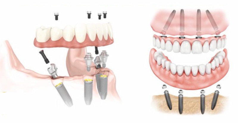 Cấy ghép implant là một phương pháp kỹ thuật áp dụng trong trồng răng vàng