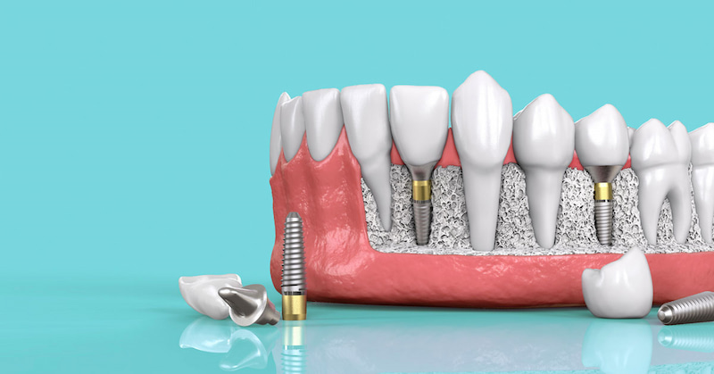 Cấy ghép implant được gọi là trồng răng vĩnh viễn nhờ tuổi thọ lâu dài