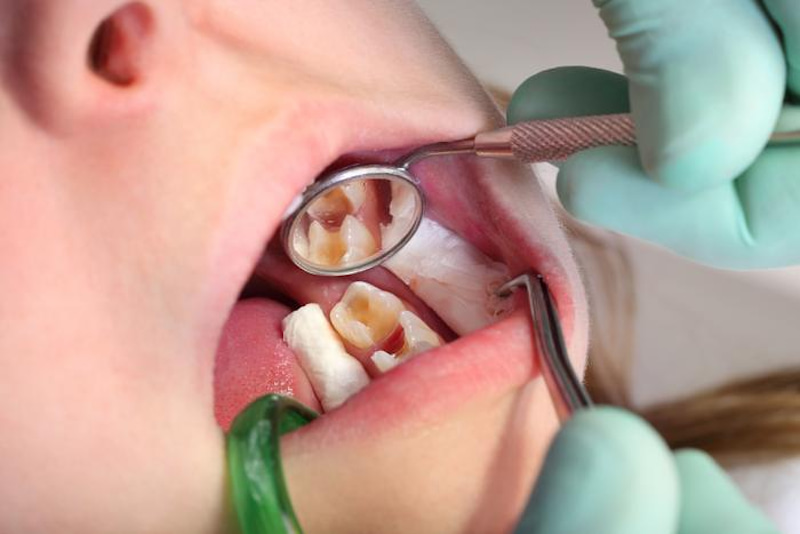 Răng bị sâu hoặc điều trị tuỷ nghiêm trọng có thể bọc sứ