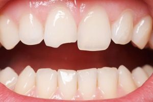 Răng cửa bị mẻ cần được khắc phục sớm đảm bảo tính thẩm mỹ