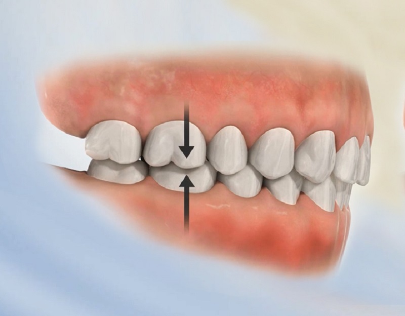 Khi răng bị sâu ở mức độ nặng thì bọc răng là phương pháp tốt nhất