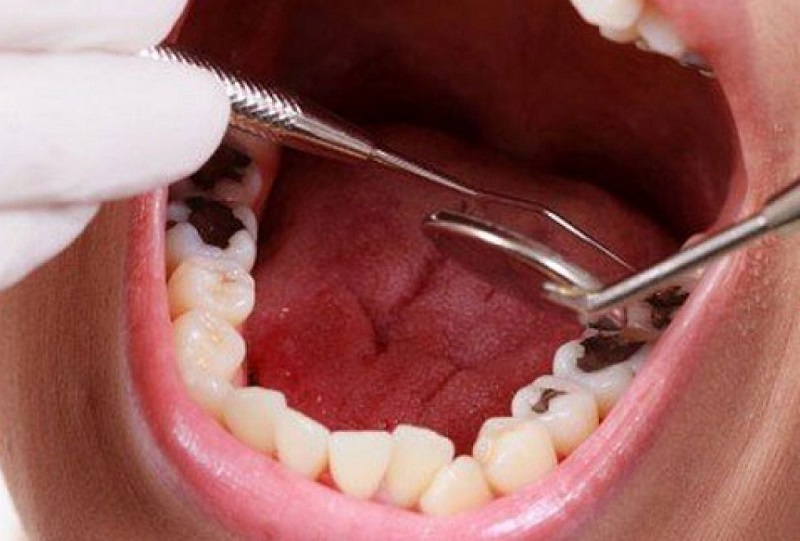 Khi răng số 7 bị sâu thì biện pháp bọc mang đến hiệu quả cao nhất