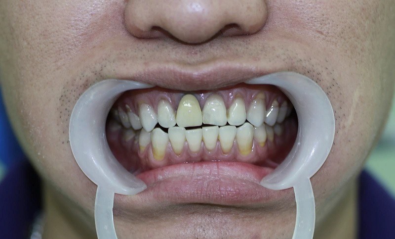 Dấu hiệu nhận biết răng sứ bị đen viền nướu
