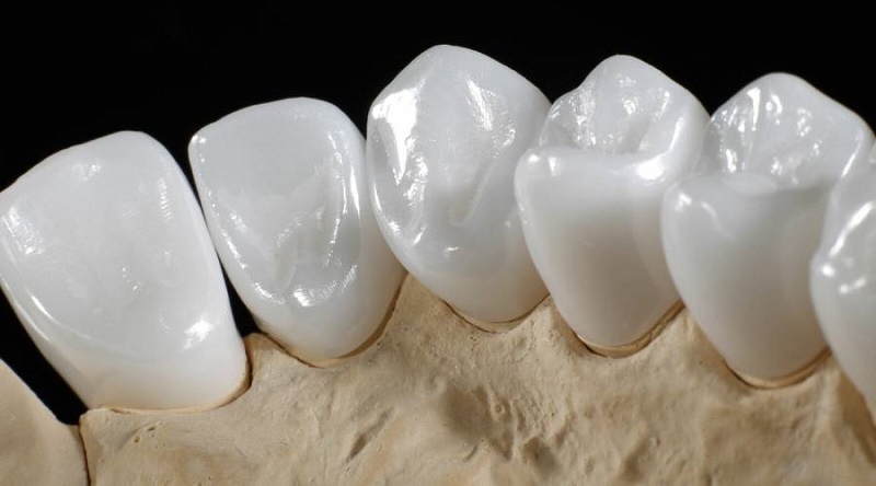 Răng sứ Emax được nhiều bác sĩ nha khoa khuyên dùng