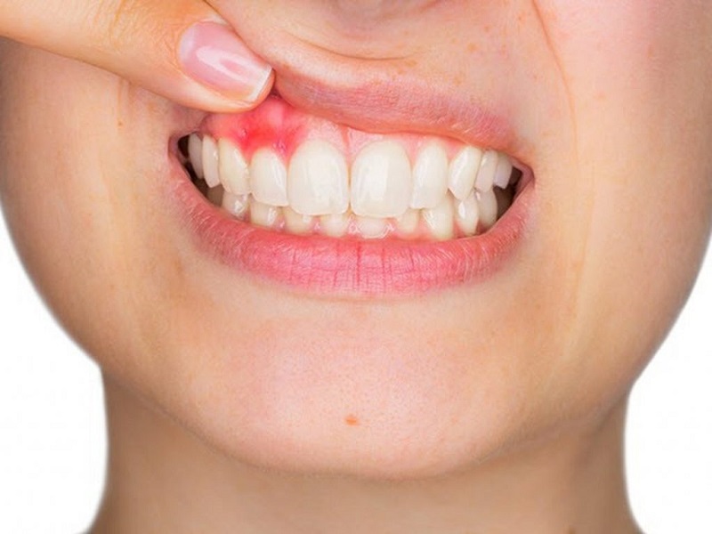 Nướu răng trở nên to hơn một cách bất thường