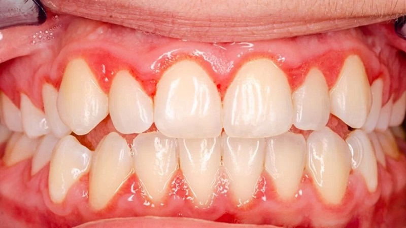 Do răng sứ xâm phạm đến khoảng sinh học của lợi gây ra tình trạng viêm lợi