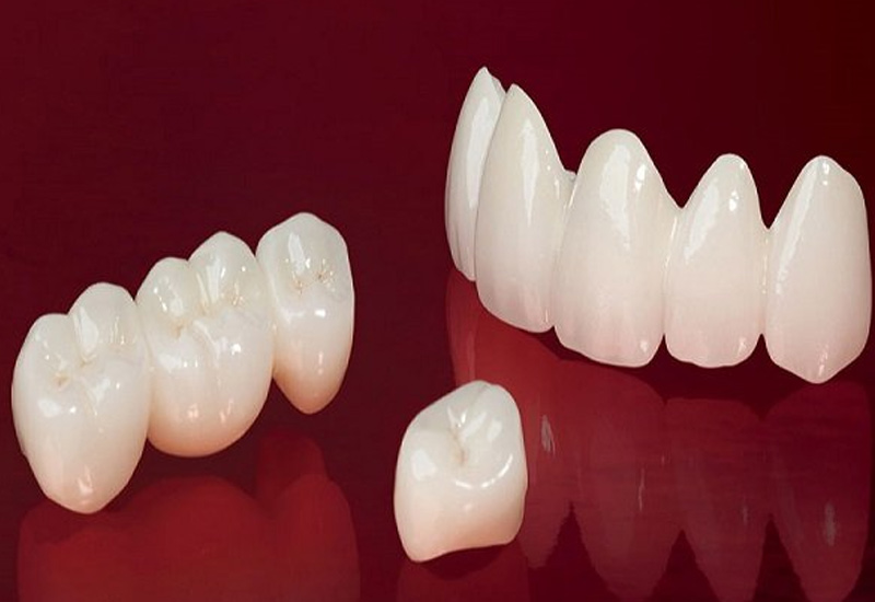 Hình ảnh răng sứ Emax