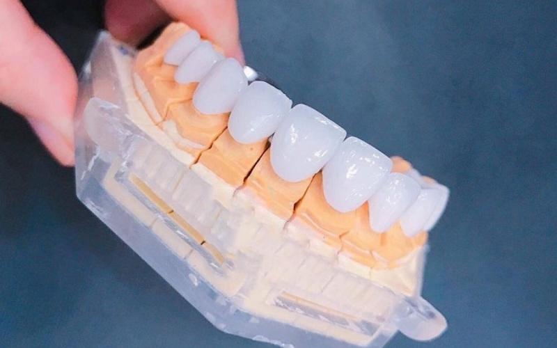 Chi phí bọc răng sứ cho răng sâu còn phụ thuộc vào nhiều yếu tố
