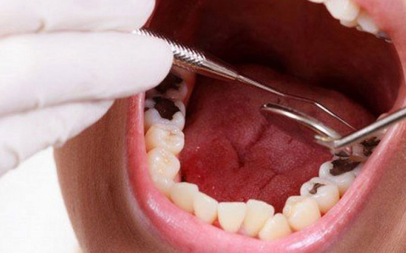 Bọc răng sứ cho răng sâu là phương pháp phục hình thẩm mỹ hiệu quả