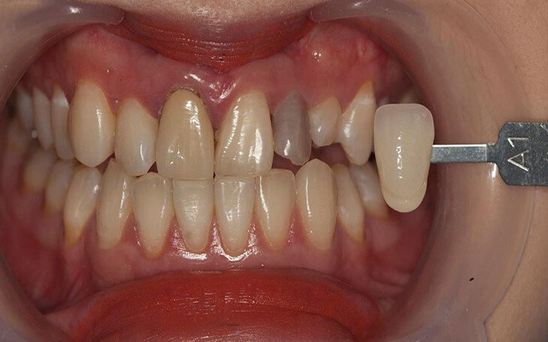 Răng bị chết tủy cần bọc sứ để bảo tồn răng thật