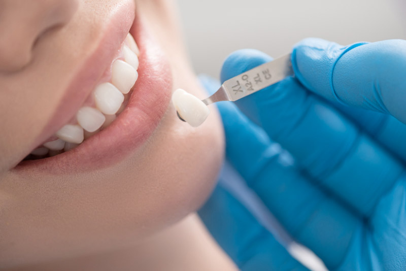Bọc răng sứ là phương pháp thẩm mỹ phục hồi tiên tiến nhất hiện nay