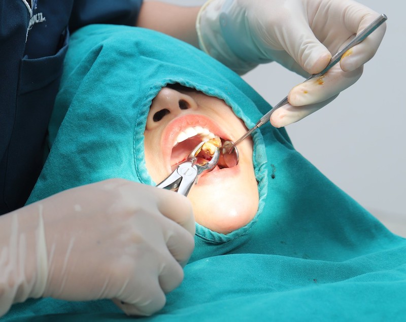 Trường hợp răng lệch lạc nhiều hoặc thừa răng cần nhổ bỏ trước khi bọc sứ