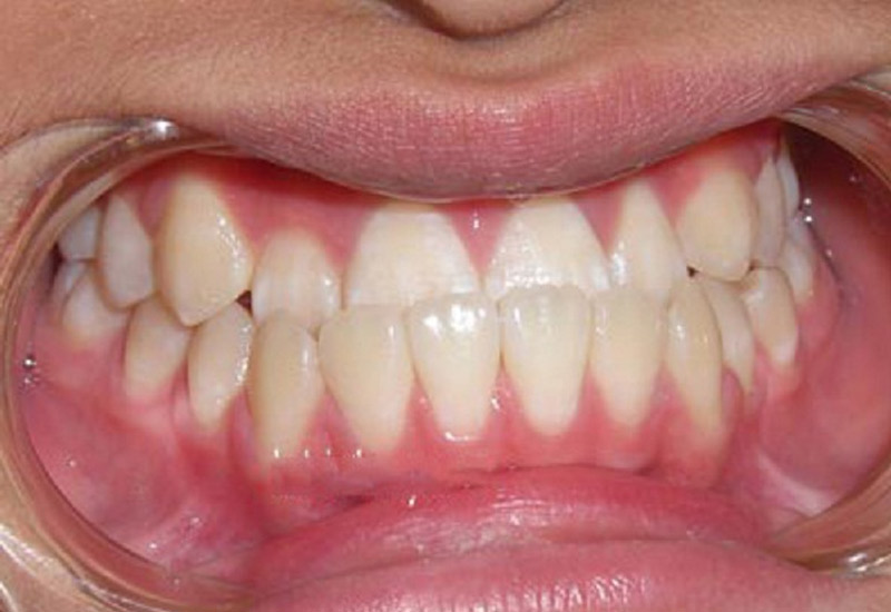 Răng móm là tình trạng khá phổ biến