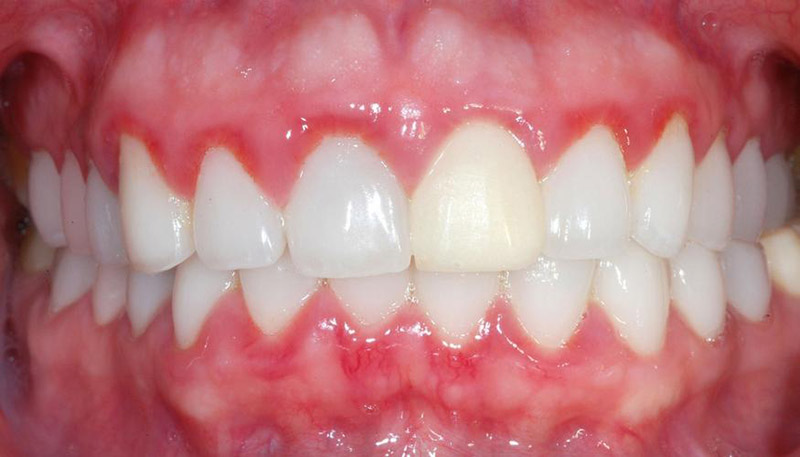 Bọc răng sứ tại địa chỉ nha khoa kém uy tín có thể dẫn tới viêm lợi, sưng nướu