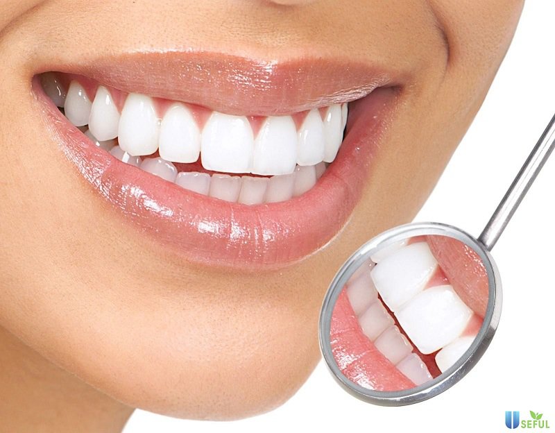 Cần chăm sóc răng miệng sạch sẽ sau khi bọc răng sứ