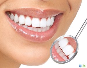 Bọc Răng Sứ Có Lấy Cao Răng Được Không? Chăm Sóc Răng Thế Nào?
