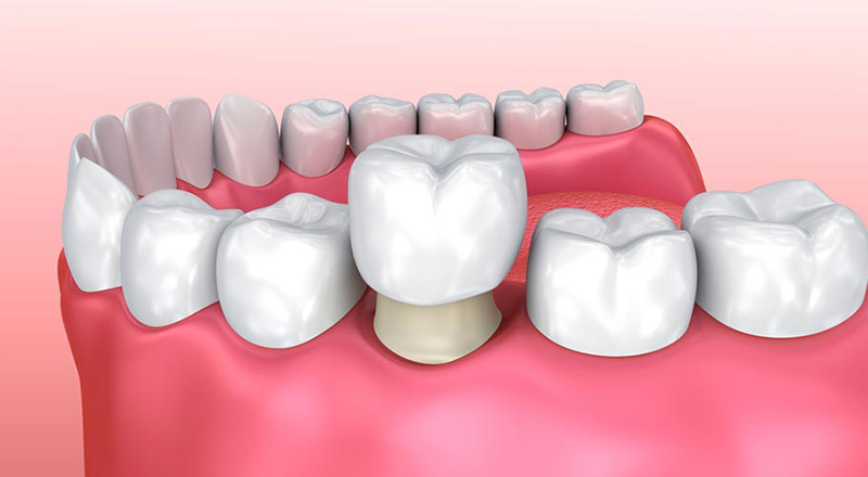 Bọc răng sứ có tháo ra được không là thắc mắc của rất nhiều khách hàng
