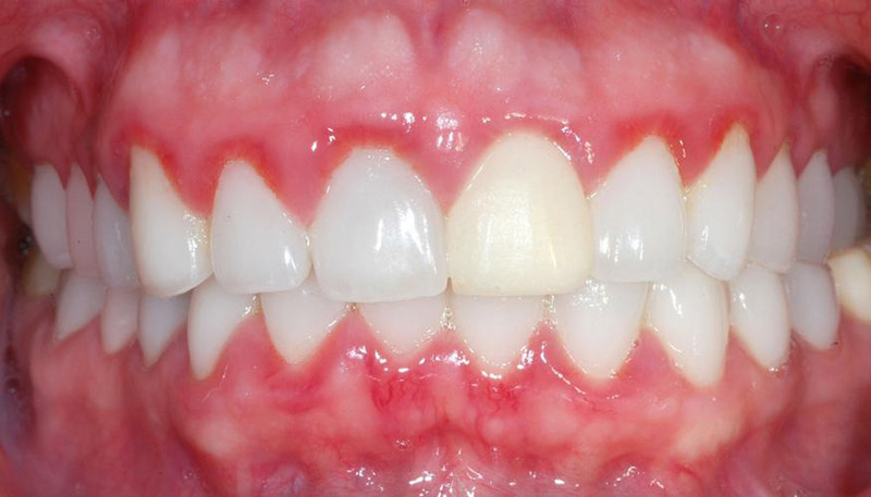 Khi răng sứ bị tụt lợi, cần tháo bỏ và lắp lại nhanh chóng