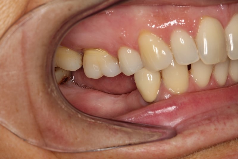Hàm răng bị mất với số lượng từ 1-3 cái liền kề nhau