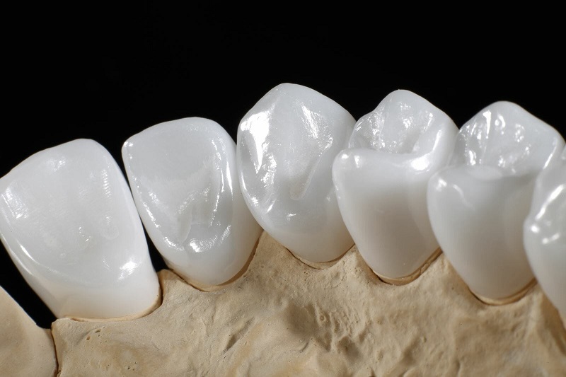 Răng sứ toàn sứ có giá đắt hơn răng sứ kim loại