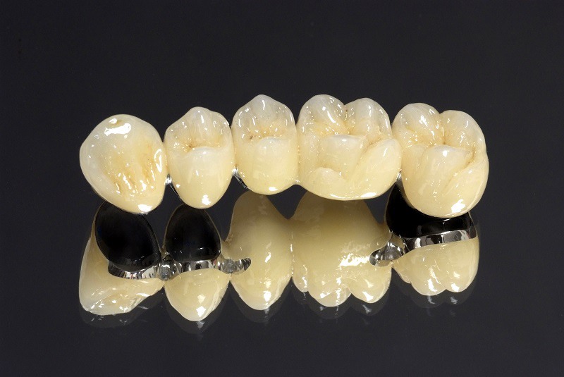Răng sứ kim loại được nhiều người ưa chuộng bởi chi phí hợp lý